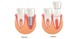 импланты vs коронки