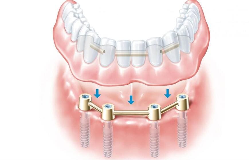 протезирование на 4 имплантах