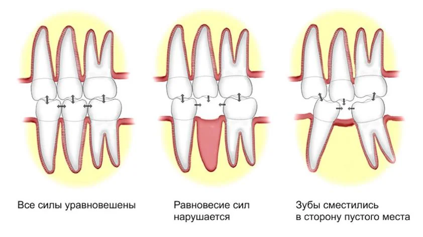 замена зубов