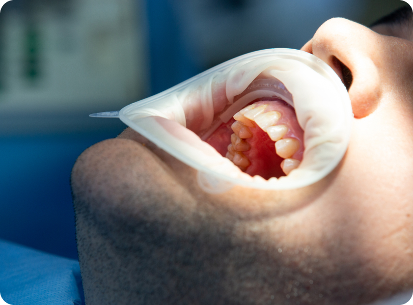 Почему кровоточат десна?