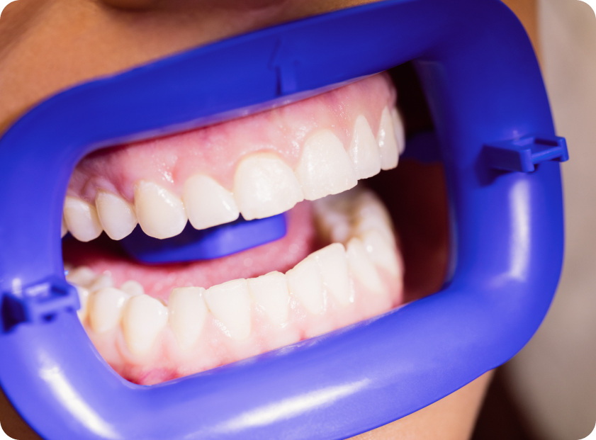 Лечение пришеечного кариеса