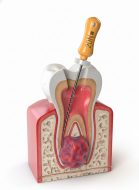 Гранулёма зуба: симптомы, эффективное лечение и профилактика в клинике «Династия врачей»